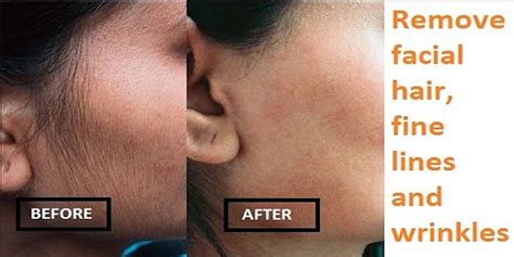 Generally, you can go for at least two options, the first being hair thinning via electrolysis, and the second being permanent hair removal. Best way to remove facial hair, fine lines and wrinkles ...