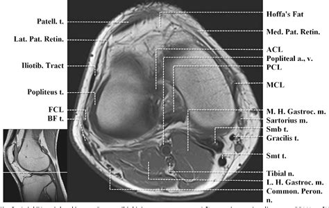 The muscles of the knee include the quadriceps, hamstrings, and the muscles of the calf. Figure 3 from Normal MR imaging anatomy of the knee. | Semantic Scholar