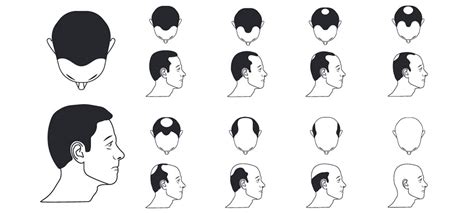 【最新】 はげ方 パターン - 最優秀作品賞 2020
