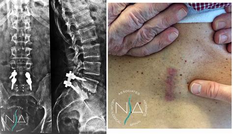 Discectomia ed artrodesi cervicale, post operatorio ...