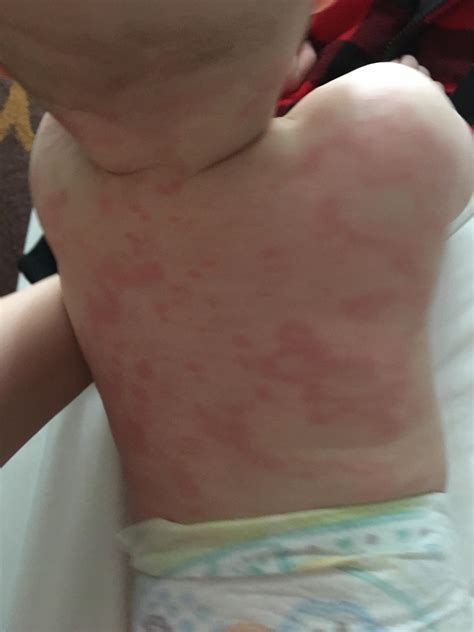 Should i see a doctor? How long do hives last?!? My poor baby is broken out ...