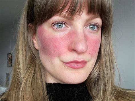 24.3m views • 211 videos. What Causes Rosy Cheeks and How Is It Managed? - Skin Care ...