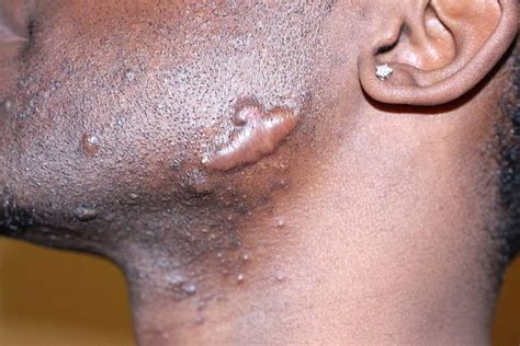 Therefore, you should always shave with some cream or gel and use a sharp blade. Keloid Causes, Symptoms | Homeopathic Treatment