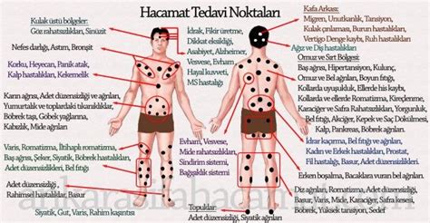 Daha önce fibromiyalji ve hassas noktalar ifadelerini duymuşsunuzdur. Hacamat Nedir? Hacamat Nasıl Yapılır? Hacamatın Faydaları ...