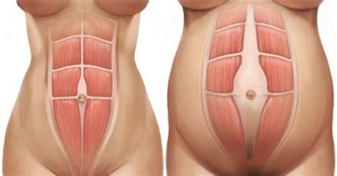 This helps to maintain a beautiful posture and a healthy backbone. Diastasis Recti Recovery - 3 Steps to Healing Diastasis ...