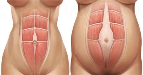 Maybe you would like to learn more about one of these? Diastasis Recti Recovery - 3 Steps to Healing Diastasis ...