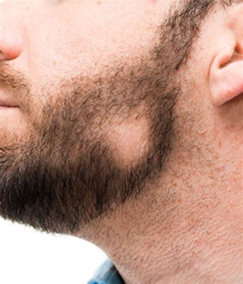 Alopecia areata e celiachia | Centro Biomedical