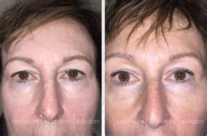 Endoscopic forehead lift the endoscopic lift is a more modern method that can be employed during a brow lift. How Much Does A Brow Lift Cost in Manhattan - Specialty ...