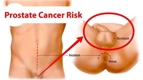 There is some disagreement among medical organizations whether the benefits of testing outweigh the potential risks. 9 Things That Affect A Man's Prostate Cancer Risk ...