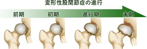 足を引きずる肩がゆれる～変形性股関節症末期の治療は薬物と ...