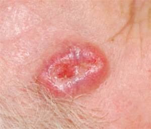 Skin Cancer 101: A review of the 3 most common skin cancers Skin Cancer  