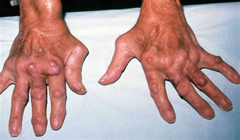 Rheumatoid arthritis is treated via surgery, medicine, and lifestyle changes; Rheumatoid nodules causes, symptoms, diagnosis & treatment