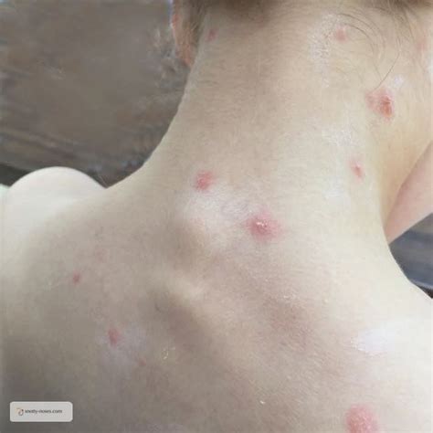 In this article, we learn what chicken pox pictures in babies are, learn the chickenpox symptoms in babies on photos and also consider the early signs of chickenpox in babies. Kids Health