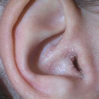 Ein geschwollener lymphknoten hinter ihrem ohr kann durch viele dinge verursacht werden. Шелушение кожи в ушах: причины появления и методы ...