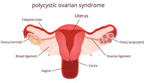 Multiple small cysts on the ovaries. What is PCOS? - Happy Healthy You