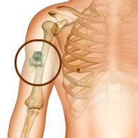 Bone cancer is one of the most common types of cancer affecting cats. Καρκίνος των οστών, Οστεοσάρκωμα, σάρκωμα Ewing ...