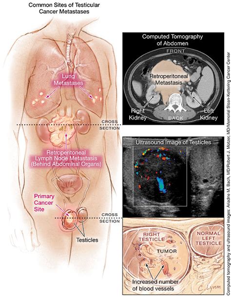 It also stated that sometimes an ultrasound won't pick up tc, hence blood results. Testicular Cancer | Oncology | JAMA | JAMA Network