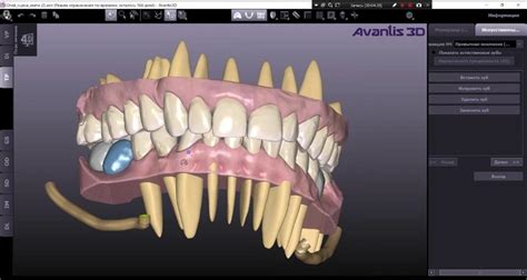 Цифровое протезирование зубов в стоматологии с программой Avantis 3D