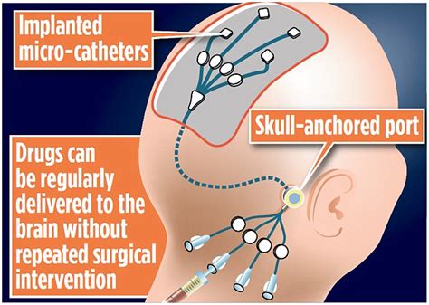 Dipgs often cause the anatomic structures located at or near the ventral pons to become. Funding plea for treatment of brain tumour that no child ...