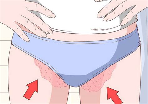 O que são essas manchas na virilha? - Tratamento Íntimo ...