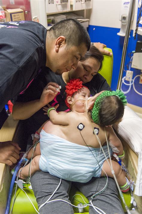 Conjoined twins Knatalye and Adeline Mata separated in ...