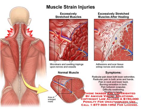 Some people also find that massages help reduce stress as. Muscle Strain Injuries