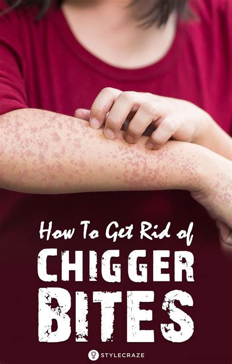 We are going to teach you how to get rid of chigger bites fast and easy through a few simple. Pin on Life hacks