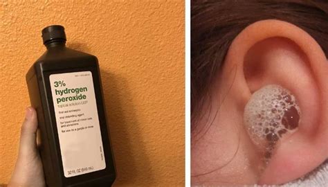 Watch the video explanation about how to put hydrogen peroxide in ears. Try out these easy and harmless ways to clean your ears ...
