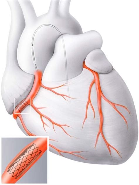 Chirurgie des artères coronaires