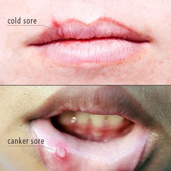 The medical term for canker sores is aphthous ulcers.. extraction des points noirs 62
