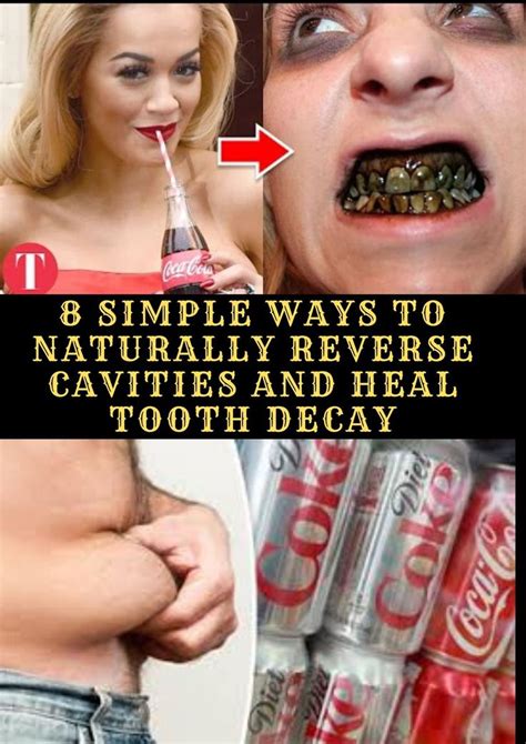 This helps to clear the tartar. 10 Simple And Natural Ways To Reverse Cavities And Heal ...