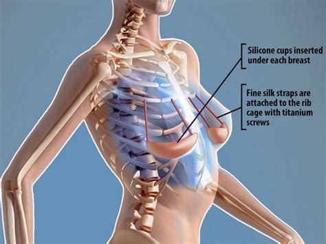 The rib cage the human rib cage, otherwise known as the thoracic cage, consists of twenty four ribs, its costal cartilages, a sternum inflammation of the thoracic cage muscles can also lead to pain under the right rib cage, specifically on the area of attachment of the breastbone and the rib cage. The end of breast implants? Miracle bra UNDER the skin ...