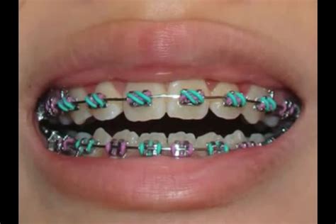 Place a small orthodontic rubber band on the tip of the tongue. Braces Rubber Bands - German Milf Pics