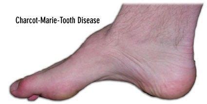 Connexion · devenir adhérent · faire un don · nous contacter. Successful Treatment Of Charcot-Marie-Tooth disease in ...