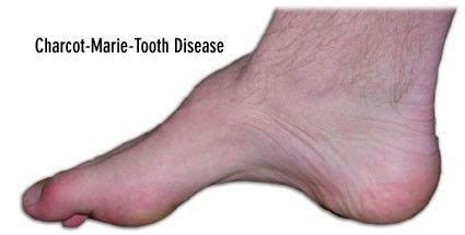 Charcot marie tooth disease (cmt) is a hereditary nerve disorder that causes muscle weakness and atrophy. Successful Treatment Of Charcot-Marie-Tooth disease in ...