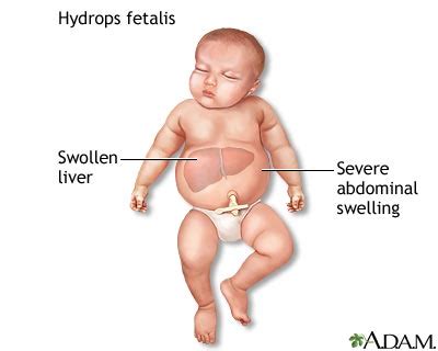 Penyebab kuning pada bayi disebabkan oleh peningkatan kadar bilirubin dalam darah. Hanya Ingin Tau: Resiko besar kawin dengan cewek bule