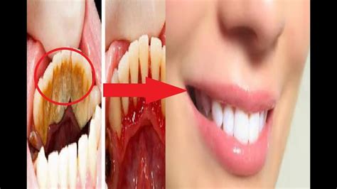 Ketika karang gigi terkena bakteri dan plak yang menumpuk maka bisa menyebabkan karang gigi berpori dan mengerak. Cara Membersihkan Karang Gigi Dengan CEPAT Secara ALAMI ...