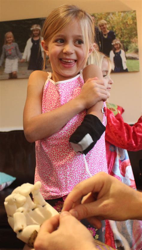 1 2 3 4 5 ). Holiday Miracle - 3D Printed Myoelectric Arm Allows Girl ...