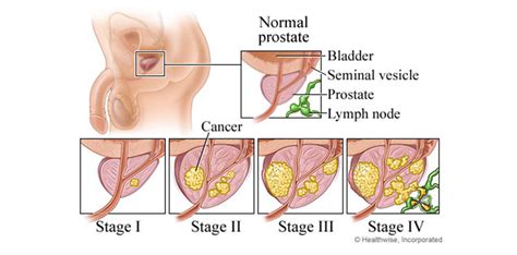 Nice clinical guideline (jan 2014) guidelines on prostate cancer; Marijuana As Treatment For Prostate Cancer - TNM NEWS ...