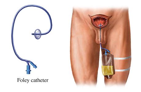 Cut the balloon port tubing, using surgical scissors, as a second alternative to remove your catheter. Urinary Catheter Care