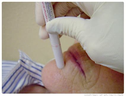 It is said to have a high response rate with few side effects. Photodynamic Therapy (PDT) Costs, Side Effects & Recovery