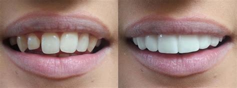 Even just a full upper set adds up quickly to over $6000 (on don't worry, you're not going to be making your own teeth! Do It Yourself Veneers - Removable Veneers For Your Teeth