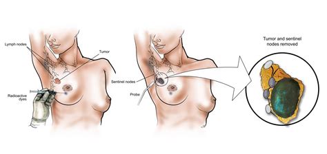 Lymph nodes play a very important role in the work of the whole organism. Lymph Node Surgery | Baylor Medicine