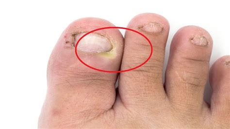 It's known worldwide for it's. how to treat ingrown toenail with tea tree oil fast - YouTube