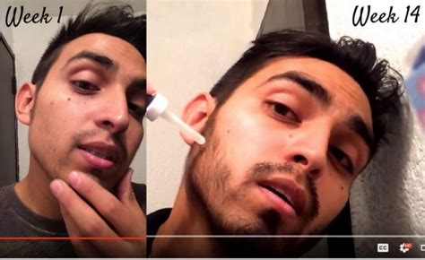 Before & after using minoxidil. Minoxidil for beard reddit - BeardStylesHQ