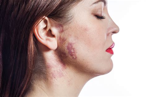 What are Pigmented Birthmarks - Apollo Hospital Blog