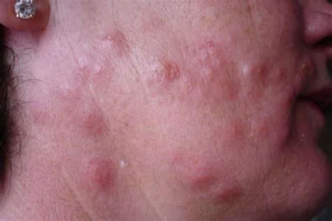 Studies show that they have a preference of biting the skin around the eyelids, and such areas as the. Severe Bed Bug Bites Reaction | TreatCure
