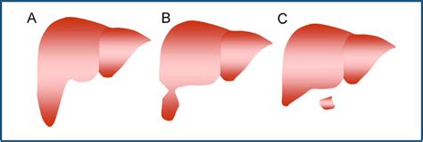 The liver is covered by a fibrous layer, known as glisson's capsule. Accessory or ectopic liver lobes. A. Sessile lobe (Riedel's lobe). B.... | Download Scientific ...