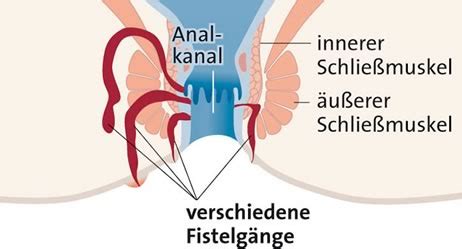 Die überschrift beschreibt mein problem. Analfistel | Apotheken Umschau