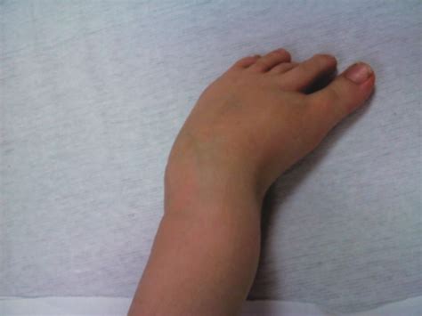 2) this is probably club foot which is appearing as swelling due to pressure effect. Clubfoot Deformities Get a Full Range of Understanding ...